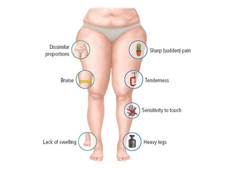 7 Easy Steps to Self-Diagnose Lipoedema & Recognize Early Signs