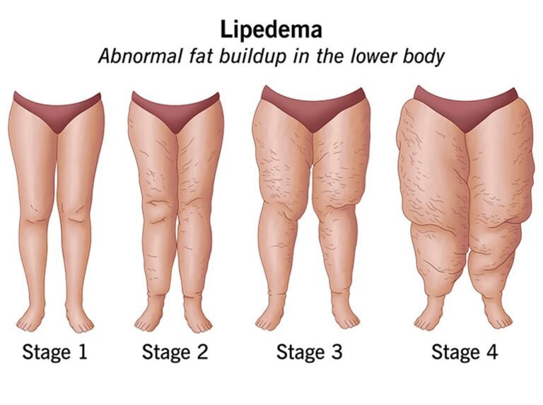 Stages of Lipoedema & Treatment Options | Dr. Purbey’s Expert Care