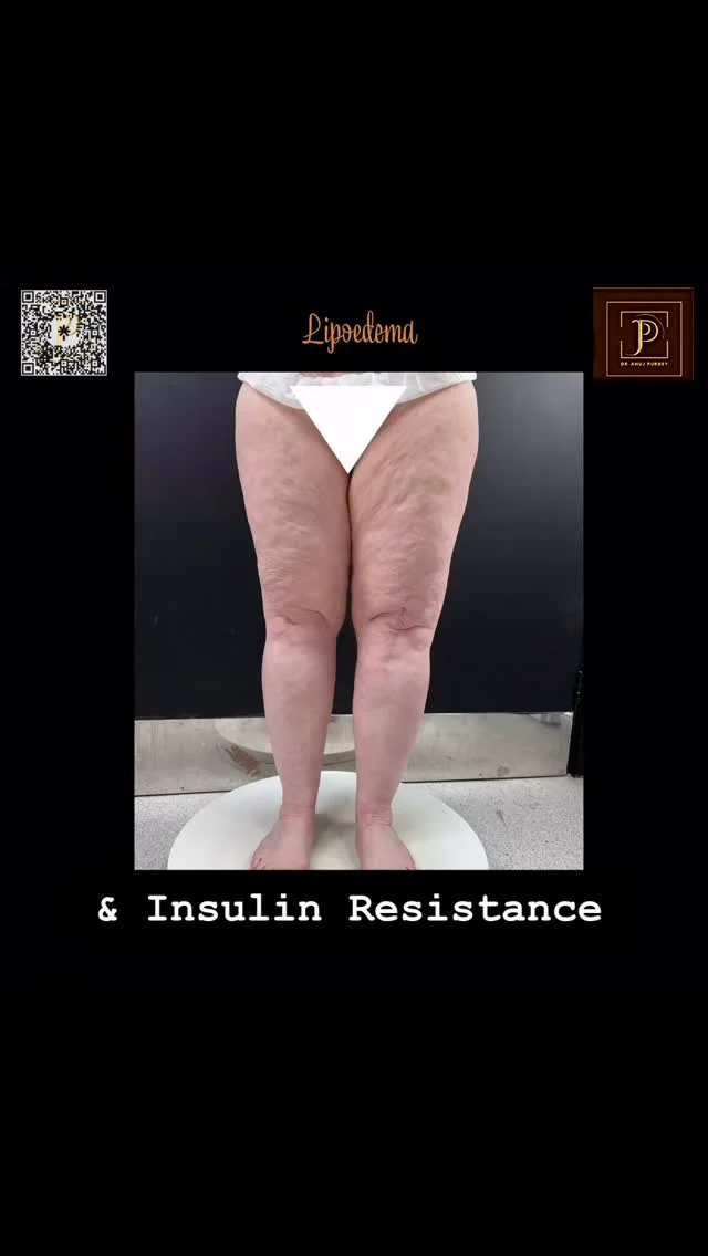 Insulin resistance occurs when your body’s cells stop responding to insulin properly, leading to increased fat storage — particularly in areas affected by Lipoedema.

📉 Even if your blood sugar is “normal,” insulin resistance can quietly sabotage your efforts, causing inflammation, fatigue, and stubborn fat accumulation.

💡 Good news: With the right management — like an anti-inflammatory diet, gentle exercise (like swimming or walking), and medical support — you can take back control.

✨ You are not lazy, and it’s not your fault. Your body is trying to tell you something.

💬 Have you struggled with weight loss despite doing everything “right”? Let’s talk about it 👇

#lipoedemaawareness #LipedemaWarrior #insulinresistance #WomensHealthMatters 
#LipoedemaSupport #InvisibleIllness #hormonalhealth #bodyinflammation 
#lipoedemauk #weightlossresistance #ChronicInflammation #PCOSAwareness 
#AntiInflammatoryLiving #LipedemaFacts #MedicalWeightLoss #LipedemaExpert 
#EndTheStigma #RealBodiesRealStories #dranujkrpurbey  #LipoedemaClinic