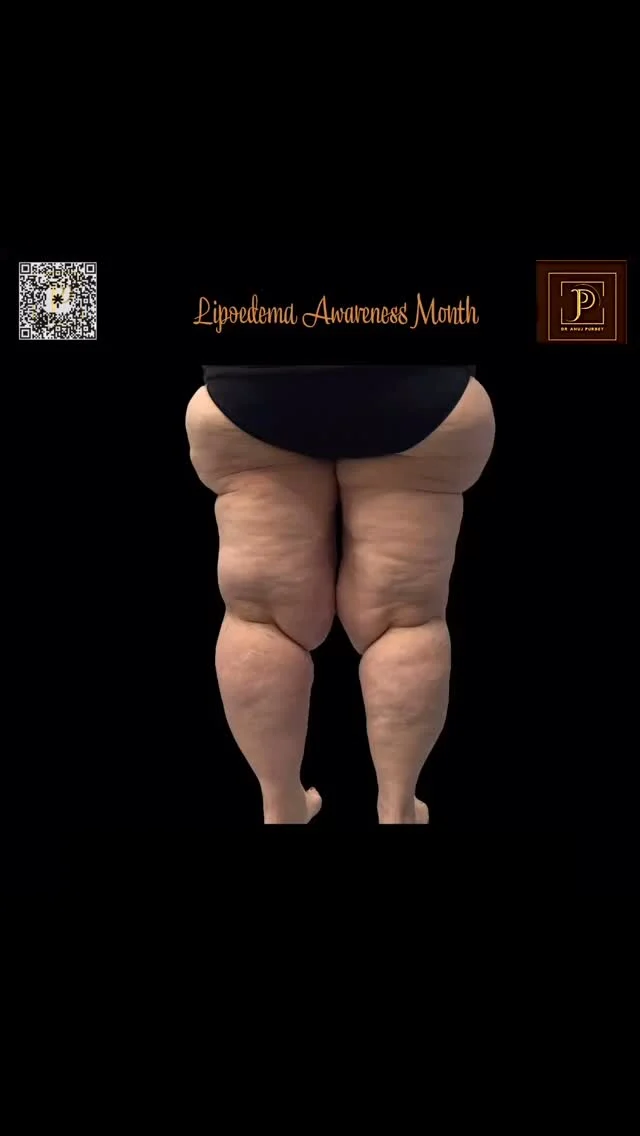 It’s NOT just fat. And it’s NOT your fault
If you’ve been misdiagnosed or told to “just lose weight,” you’re not alone. Lipoedema is often confused with obesity or lymphoedema — but it’s a real medical condition that needs a different approach.
 The Problem: ⚠️ Painful, heavy legs ⚠️ Fat that won’t shift — even with diet & exercise ⚠️ Easy bruising ⚠️ Constant swelling or tightness ⚠️ Feeling dismissed or misunderstood by doctors

The Difference Matters: ✨ Lipoedema: Symmetrical fat build-up (mostly legs, arms), painful, not diet-related ✨ Obesity: General body fat increase, usually lifestyle-linked ✨ Lymphoedema: Swelling due to lymphatic fluid, often one-sided

We help women recognise these key signs — and take back control of their health with real answers and treatment options that work.

 #LipoedemaAwareness #ItsNotJustFat #LipoedemaSupport #LipoedemaVsObesity #LymphoedemaAwareness #LegPainRelief #BodyConfidenceJourney #Misdiagnosed #WomensHealthMatters #HeavyLegs #PainfulFat #KnowTheDifference #ChronicSwelling #EmpowerYourHealth #LipoedemaWarrior #LipoedemaCommunity
#dranujkrpurbey