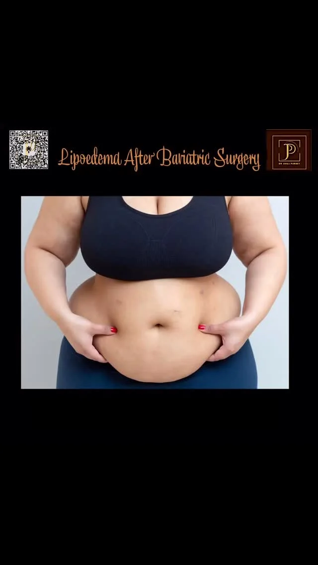 Even after bariatric and metabolic surgery, many women still struggle with painful, disproportionate fat in their legs and arms. This condition is called Lipedema – and surgery alone doesn’t make it go away.
A recent scoping review ‘Lipedema after Bariatric and Metabolic Surgery: A Scoping Review ´highlights:
 ➡️ Lipedema often goes undiagnosed in patients with obesity ➡️ Weight loss post-surgery doesn’t fully reduce lipedema fat ➡️ Patients still report pain, mobility issues & bruising ➡️ Proper diagnosis is crucial for managing expectations ➡️ Specialised treatments, like VASER liposuction, may still be needed

💬 “Lipedema is not caused by lifestyle – and can persist even after dramatic weight loss.”

📌 If you’ve had weight loss surgery but still feel something’s “not quite right” with your legs – lipedema could be the missing link.

🩻 Early diagnosis = better results
 🛠️ Treatments like VASER Lipo can help reduce pain & improve quality of life

🔗 DM us to learn more or book a consultation
 #lipedema #lipoedema #lipo #bariatricsurgery #lipedematreatment #vaserliposuction #dranujkrpurbey #lipedemasupport #womenshealth #legpain #bodyconfidence