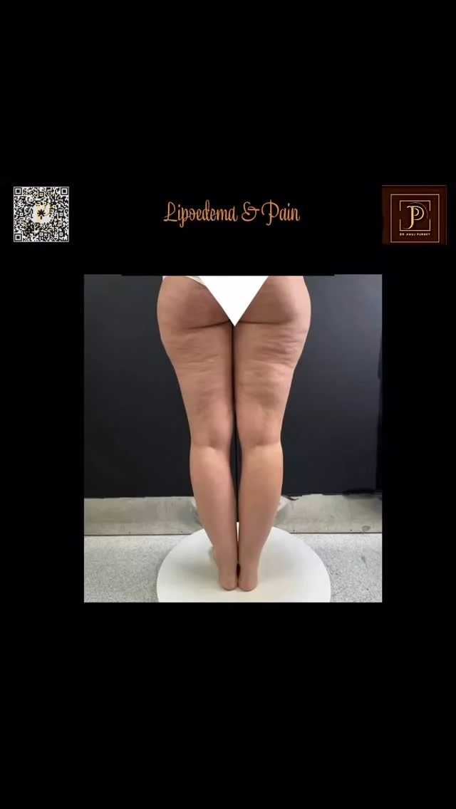 Lipoedema is more than stubborn fat — it’s a chronic fat disorder that can cause daily pain and discomfort.

🔍 Why does Lipoedema cause pain?
1️⃣ Abnormal Fat Tissue Growth Lipoedema fat grows in an uneven, fibrotic way — especially around the hips, thighs, legs, and arms. This tissue can press against nerves and blood vessels, leading to tenderness and pain.
2️⃣ Inflammation The fat cells in Lipoedema are chronically inflamed, releasing chemicals that increase pain sensitivity. This also contributes to the feeling of heaviness, burning, or aching.
3️⃣ Fluid Retention & Swelling As Lipoedema progresses, the lymphatic system struggles to drain properly. The fluid buildup (edema) increases pressure in the tissues, worsening pain and stiffness.
4️⃣ Easy Bruising Small blood vessels (capillaries) in Lipoedema fat are fragile. Even minor pressure can cause bruises and microtrauma, triggering pain and visible marks.
5️⃣ Mechanical Strain Carrying heavy, disproportionate limbs puts strain on joints, muscles, and ligaments, causing secondary pain in the knees, hips, and back.

💡 Pain isn’t in your head — it’s in your tissue.
 
✨ Treatments like manual lymphatic drainage, compression therapy, and VASER liposuction can significantly reduce pain and improve mobility.

#LipoedemaAwareness #lipedemafighter #lipoedemapain #ChronicPainRelief #LipoedemaTreatment #dranujkrpurbey #drlegs #LipoedemaSupport #VASERLipo #LymphaticHealth #fibroticfat #WomensHealth #viralhealthtips