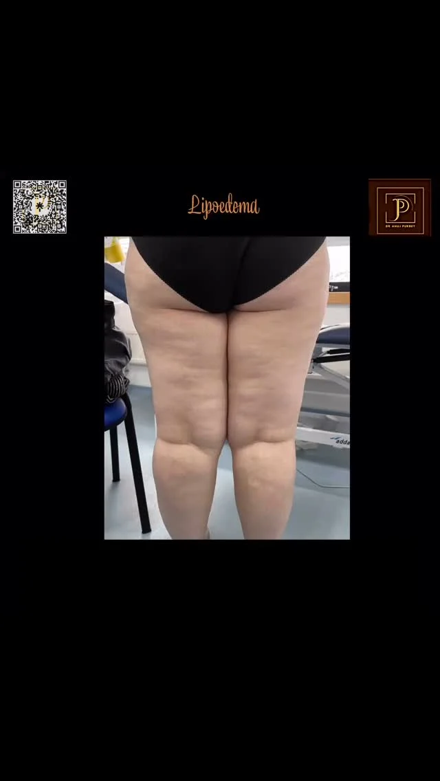 Living with Lipoedema means being extra mindful of what you put into your body — and alcohol is one of the worst culprits. Here’s why:

🔹 Triggers Inflammation Lipoedema is already an inflammatory condition. Alcohol further fuels this inflammation, worsening pain, swelling, and tenderness.
🔹 Impairs Lymphatic Flow Your lymphatic system helps reduce fluid build-up. Alcohol slows lymphatic drainage — increasing the risk of heaviness, fluid retention, and tissue fibrosis.
🔹 Slows Fat Metabolism Alcohol affects your liver’s ability to metabolise fat properly, which is especially problematic for those with abnormal fat storage like in Lipoedema.
🔹 Worsens Hormonal Imbalance Lipoedema is hormone-related. Alcohol disrupts hormone balance, particularly estrogen, potentially accelerating fat deposition in legs, hips, and arms.
🔹 Leads to Poor Food Choices Let’s be honest — alcohol lowers willpower. You’re more likely to reach for salty, processed, or sugary foods that cause inflammation and bloating.

Bottom Line: Even “just one glass” can flare up your symptoms, delay progress, and set back your healing. 
✨ Think long-term health over short-term indulgence.

#LipoedemaAwareness #lipe #lipedema #LipoedemaUK #LipoedemaSupport #InflammationFree #AlcoholFreeLiving #ChronicIllnessSupport #LymphaticHealth #HormoneHealth #HealingWithFood #LipoedemaDiet
#dranujkrpurbey