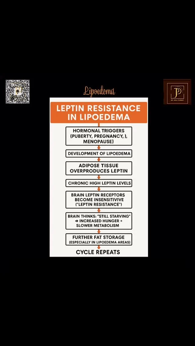 Lipoedema isn’t just about stubborn fat — it’s a complex medical condition. One key player? Leptin – the hormone that regulates hunger and fat storage.

In women with Lipoedema, leptin resistance is common. This means the brain stops responding properly to leptin’s signals, leading to:
❌ Disrupted appetite control ❌ Increased fat storage (especially in the lower body) ❌ Poor fat metabolism ❌ Chronic inflammation

Even with diet and exercise, the body may hold on to fat, making Lipoedema feel impossible to manage without targeted treatment.

🩺 Understanding the science behind Lipoedema helps us treat it more effectively – whether that’s through conservative measures or advanced options like VASER liposuction.

📚 Knowledge is power. Let’s break the stigma and spread awareness.

#LipoedemaAwareness #LipoedemaUK #lipedema #leptinresistance #LipoedemaSupport #LipoedemaTreatment #LipoedemaFacts #LipoedemaWarrior #HormoneHealth #ChronicCondition #WomensHealth #dranujkrpurbey #VASERLipo #lipoedemaeducation #InvisibleIllness #hormonalhealth #metabolichealth #BodyScience