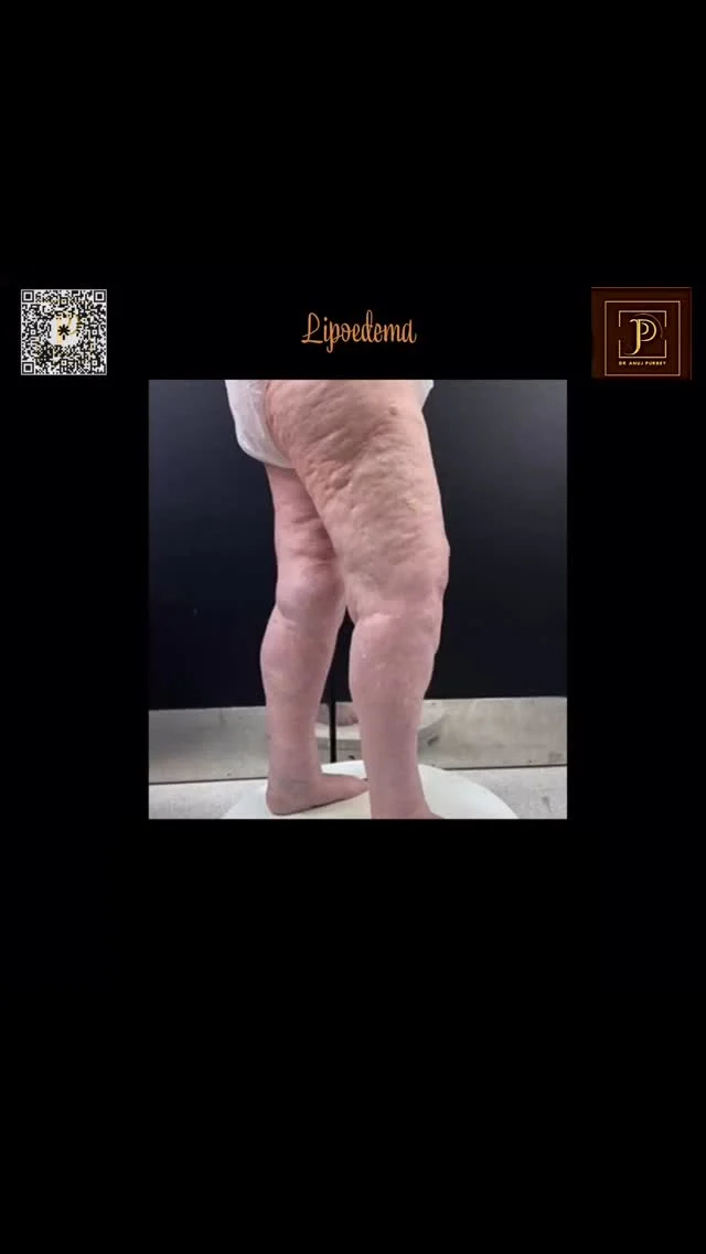 If you’re living with Lipoedema, you’ve likely noticed that some days feel worse than others. One silent trigger? Food intolerances that fuel chronic inflammation.

🥗 Unlike allergies, food intolerances don’t cause immediate reactions – but they can quietly worsen swelling, tenderness, and fatigue over time.
 
👀 Signs your body might be reacting to food:
🚨 Increased pain or heaviness after meals 🌪️ Persistent bloating or digestive issues 💤 Low energy or brain fog 🧊 Feeling more inflamed without clear cause
 
✅ How to identify your food triggers:
📔 Track your meals & symptoms Note what you eat and how your body responds over 2–4 weeks.
🚫 Try an elimination diet (with medical supervision) Remove common culprits like gluten, dairy, soy, and processed foods, then reintroduce slowly.
🧬 Consider food intolerance testing IgG blood tests can highlight hidden sensitivities contributing to inflammation.

💡 Why it matters: Reducing inflammatory triggers can make a huge difference in your Lipoedema management, especially when combined with advanced treatments like VASER liposuction.

👨‍⚕️ I’m Dr Anuj Kr Purbey, here to support your Lipoedema journey – not just with surgery, but with real lifestyle solutions.

#lipoedema #lipe #lipodepapada #LipoedemaAwareness #foodintolerance #chronicinflammation #lipoedemasupport #HolisticLipoedemaCare  #vaserlipo #dranujkrpurbey